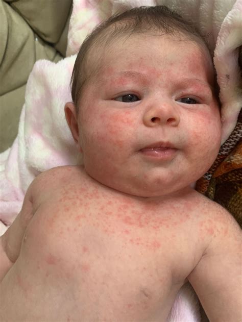 Baby Heat Rash On Back