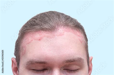 Red Psoraitic Spot On Hairline Dermatological Disease Stress
