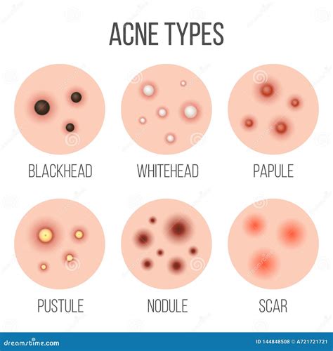 Creative Illustration Types Of Acne Pimples Skin Pores Blackhead Whitehead Scar Comedone