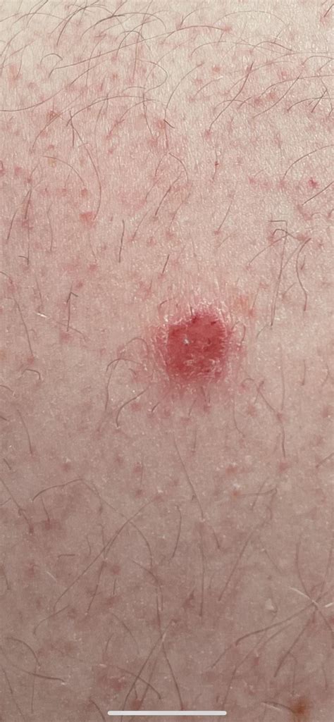 Red Elevated Mole With A Black Scab On It Rskin