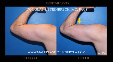Biceps And Triceps Implants Male Plastic Surgery Los Angeles