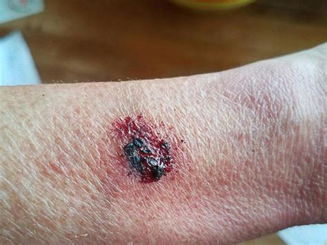 Woman Says She Suffered 2nd Degree Burns After Her Fitbit Exploded