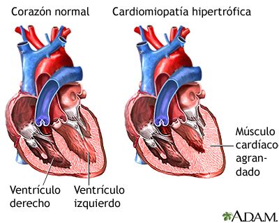 Miocardiopatía hipertrófica MedlinePlus enciclopedia médica