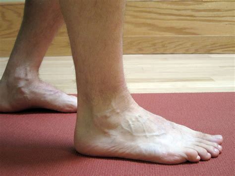 Ankle Sprains Acute Phase Part I Of Iii The Physical Therapy Advisor