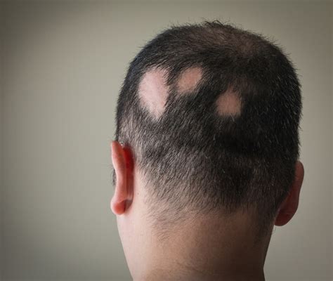 Alopecia Cos Cause E Come Si Riconosce Dai Sintomi