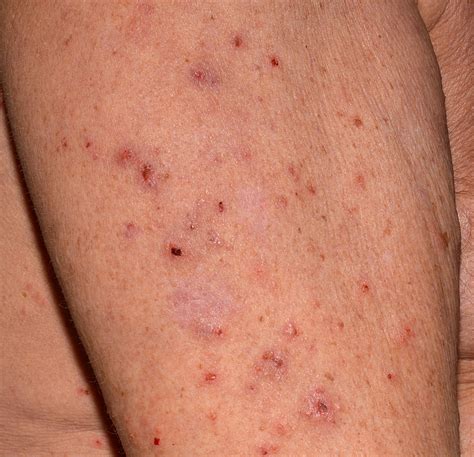 Scabies Treatment Topical Medications Vs Scabicide Therapy