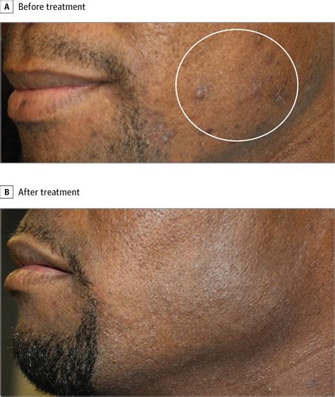 Laser Treatments For Postinflammatory Hyperpigmentation A Systematic