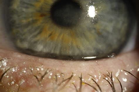 Herpetic simplex keratitis, also known as herpetic keratoconjunctivitis and herpesviral keratitis, is a form of keratitis caused by recurrent herpes simplex virus (hsv) infection in the cornea.:370. A young immunocompetent patient with bilateral immune ...