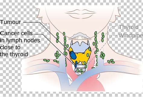 Cervical Lymph Nodes Thyroid Cancer Paratracheal Lymph Nodes Png