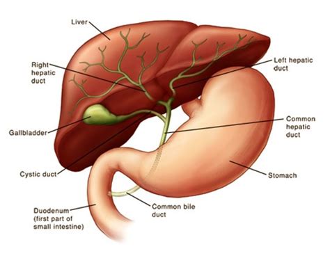 Cholecystoduodenal fistula is present 4. Gallbladder Sludge - Treatment, Symptoms, Removal, Diet ...