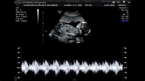 (source) this is a lot faster than most parents expect to hear. Ultrasound (20 weeks pregnant) - YouTube