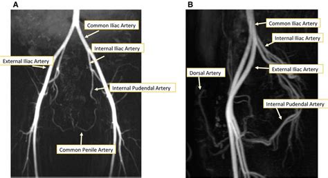 Normal Arterial Anatomy On Mr Angiography A Coronal B Sagittal