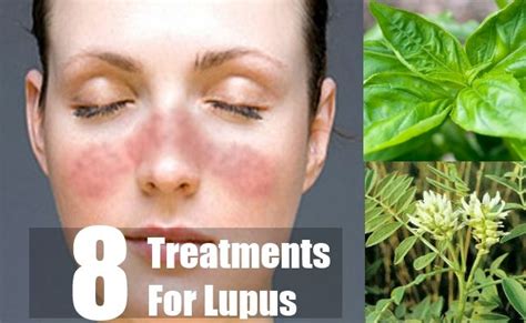 8 Treatments For Lupus Lupus Natural Cures Natural Remedies