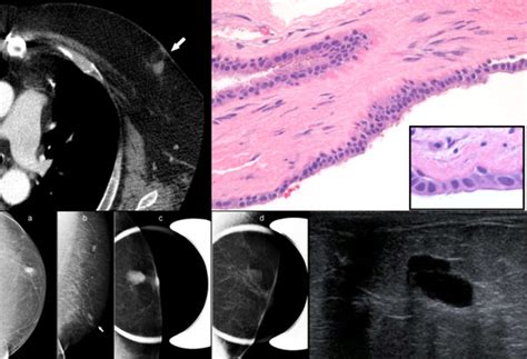 Benign Breast Cyst Without Associated Gynecomastia In A Male Patient A