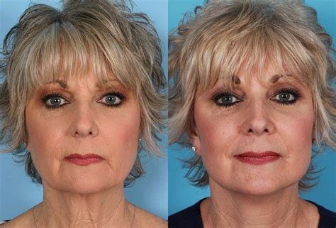 What are the benefits of mesotherapy? Limited Incision Facelift | Austin, TX