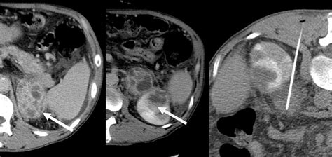 Left Adrenal And Renal Abscesses Six Months Later Ab Contrast Ct