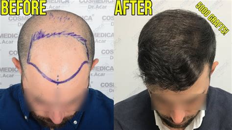 Amazing Hair Transplant Transformations For Norwood Hair Loss Youtube