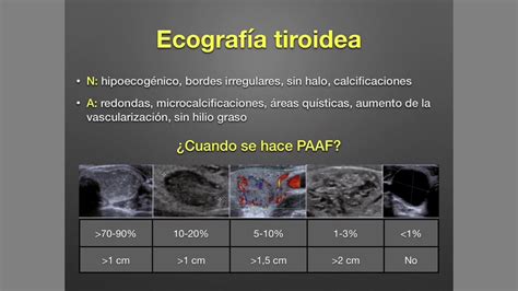 Tiroides: Nódulo tiroideo y Cáncer de Tiroides - YouTube