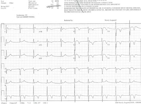 Pedi Cardiology Ekg Junctional Rhythm With Retrograde P Waves