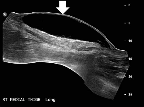 MorelLavallee Lesion Initially Diagnosed as Quadriceps Contusion