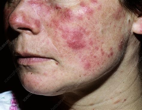 Lupus Erythematosus On The Face Stock Image C0131029 Science