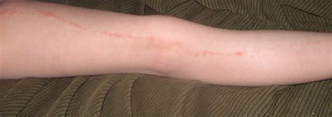 Red Itchy Bumps On Skin In Lines Images And Photos Finder