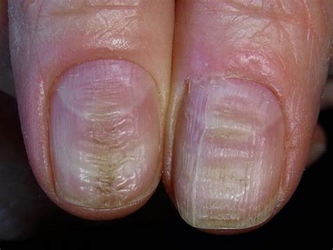Ridges On Fingernails Causes Treatment Horizontal Vertical Healthmd