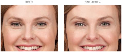 BOTOX | Crows Feet | Before and After Galleries | Pictures ...