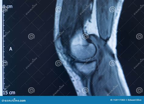 Knee Injury Mri Mcl Tear Stock Image Image Of Orthopedic 154117383