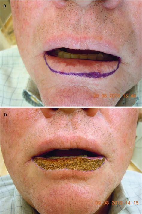 Surgical Management Of Squamous Cell Carcinoma Of The Lip Oncohema Key
