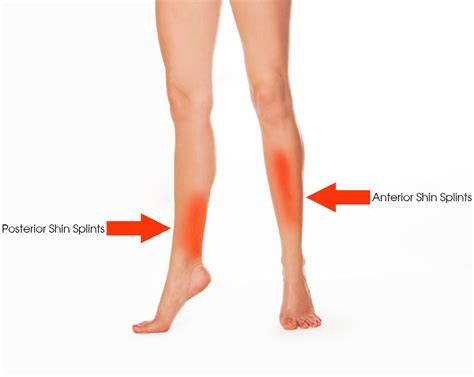 Shin Splints Orthofit Foot Ankle Biomechanics Care Clinic In Mumbai