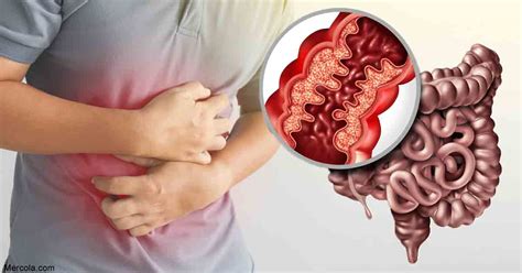 Crohns Disease — An Introduction