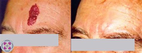 Laser Birthmark Removal And Reduction