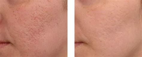 Acne Scar Treatment Medical Day Spa Of Chapel Hill