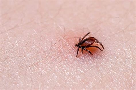 Bug Bite Symptoms You Should Never Ignore Readers Digest