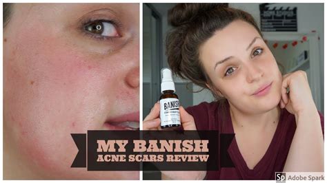 Banish Acne Scars Review And Demo Youtube