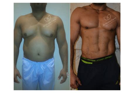 Six Pack Surgery For Men Abdominal Liposuction Men