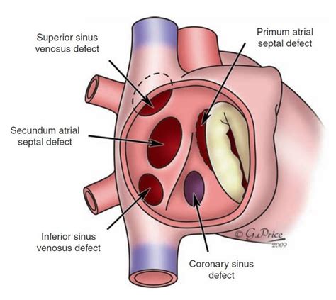 Heart Asd Ostium Google Search Atrial Septal Defect Diagnostic