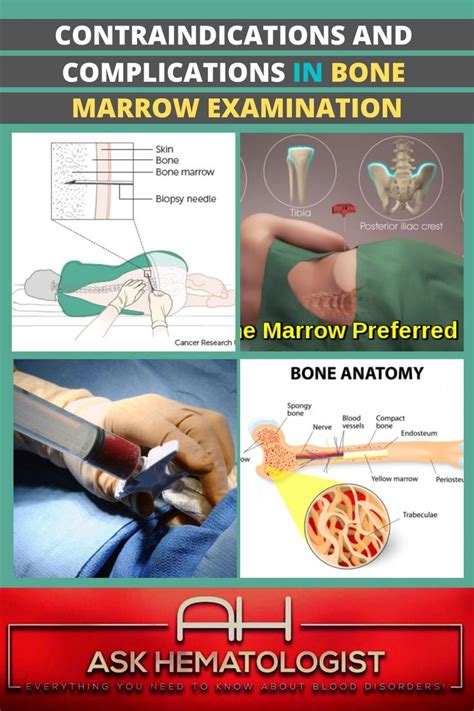 Bone Marrow Examination | Ask Hematologist | Understand Hematology in