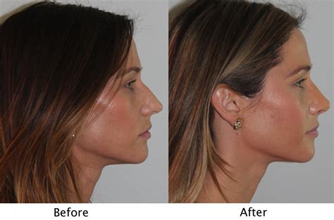 Deviated Septum Surgery Before And After