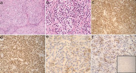 Primary Mediastinal Large B Cell Lymphoma Diagnostic Challenges And