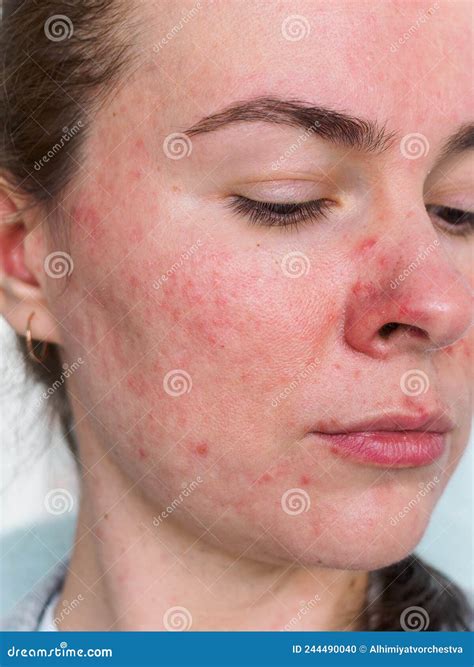 Face Of Young Woman With Rosacea Stock Photo Image Of Disease