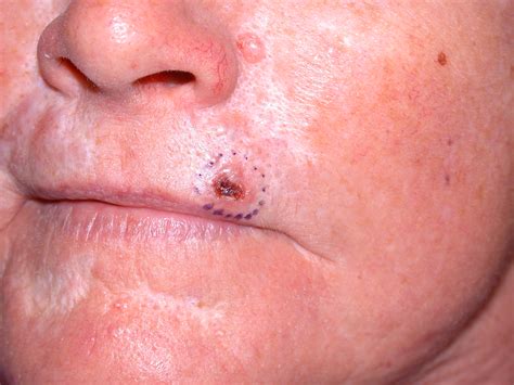 Superficial Basal Cell Carcinoma Nose