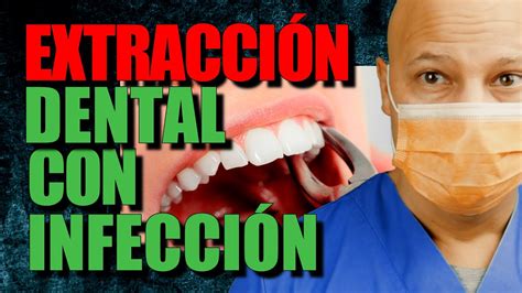 Extraccion Dental Con Infeccion 👈 Youtube