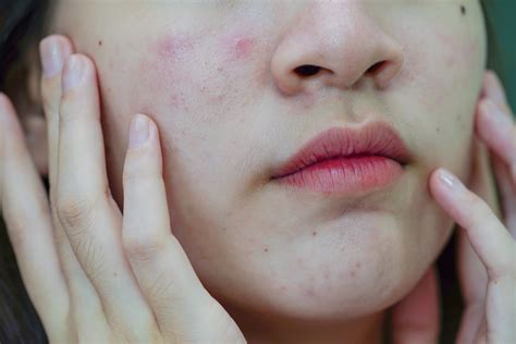 Liszaj wszechobecne choroby skóry przyczyny objawy i leczenie