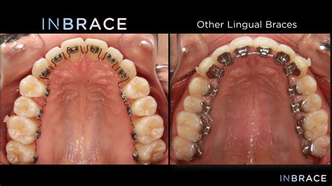 Inbrace™ Lingual Braces Clarity Orthodontics
