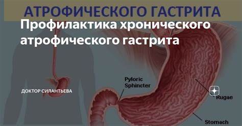 Профилактика хронического атрофического гастрита | Доктор Силантьева | Дзен Картинка - Профилактика хронического атрофического гастрита | Доктор Силантьева | Дзен