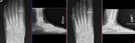 Midfoot Arthritis Patient Stories Paul H Kim Md