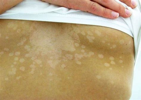 This Skin Fungus Is Super Common And Youll Probably Get It At Some