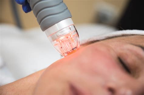 INFINI Microneedling Fractional RF For Acne Scar Reduction Heres